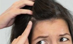 Как избавиться от перхоти